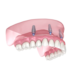 Schematische Darstellung der All-on-4-Methode mit vier Implantaten im Kiefer